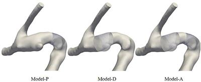 Hemodynamic indicators of the formation of tandem intracranial aneurysm based on a vascular restoration algorithm